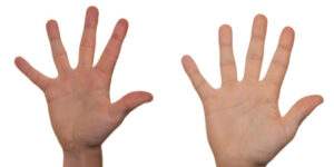 Dystrofie CRPS letsel, posttraumatische dystrofie, symptomen dystrofie, oorzaak dystrofie, behandeling dystrofie,